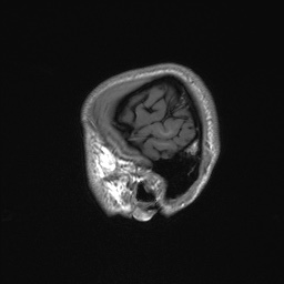 Callosal dysgenesis with interhemispheric cyst (Radiopaedia 53355-59335 Sagittal T1 17).jpg