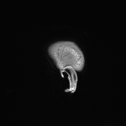 Callosal dysgenesis with interhemispheric cyst (Radiopaedia 53355-59335 Sagittal T1 172).jpg