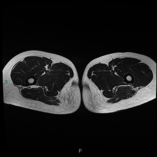 File:Canal of Nuck cyst (Radiopaedia 55074-61448 Axial T2 30).jpg