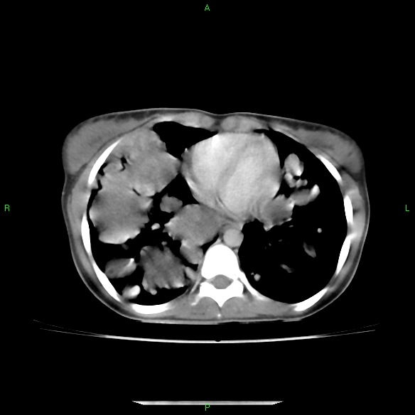 File:Cannon ball metastases - synovial sarcoma (Radiopaedia 26135-26271 C 23).jpg