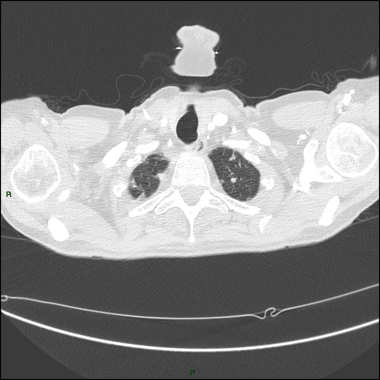 Cannonball metastases (Radiopaedia 82110-96150 Axial lung window 23).jpg