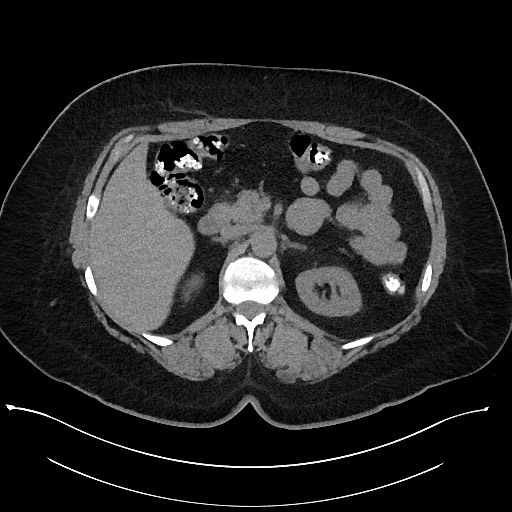 Carcinoid tumor - terminal ileum (Radiopaedia 60931-68740 Axial non-contrast 34).jpg