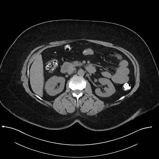 Carcinoid tumor - terminal ileum (Radiopaedia 60931-68740 Axial non-contrast 43).jpg