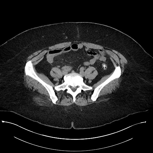 Carcinoid tumor - terminal ileum (Radiopaedia 60931-68740 Axial non-contrast 82).jpg