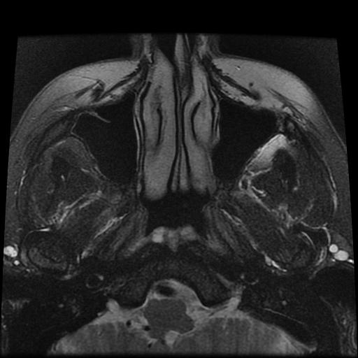 File:Carcinoid tumor of the ileum with metastasis to orbit (Radiopaedia 28165-28424 Axial T2 1).jpg