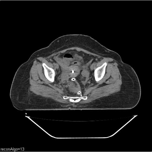 Carcinoma cervix- brachytherapy applicator (Radiopaedia 33135-34173 Axial non-contrast 26).jpg