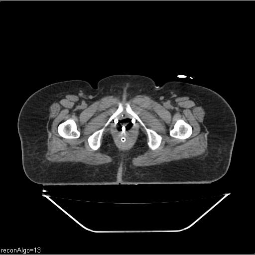 File:Carcinoma cervix- brachytherapy applicator (Radiopaedia 33135-34173 Axial non-contrast 47).jpg