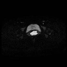 Carcinoma of the cervix (Radiopaedia 89018-105858 Axial DWI 30).jpg
