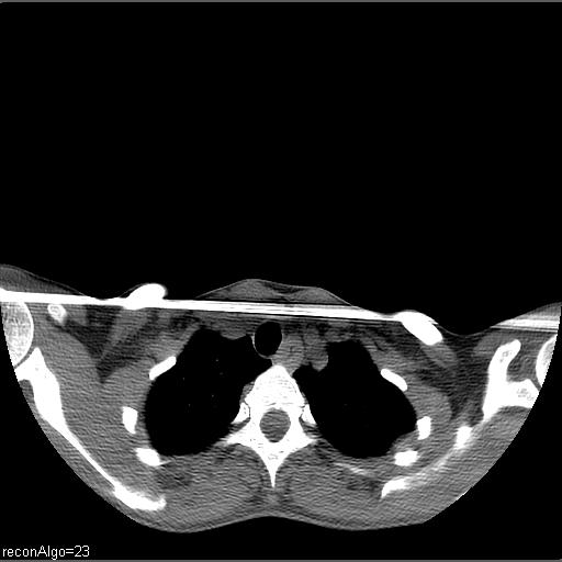 Carcinoma of the maxillary antrum (Radiopaedia 53805-59888 Axial non-contrast 2).jpg