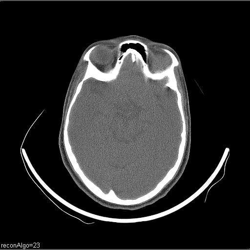 File:Carcinoma of the maxillary antrum (Radiopaedia 53805-59888 Axial non-contrast 78).jpg