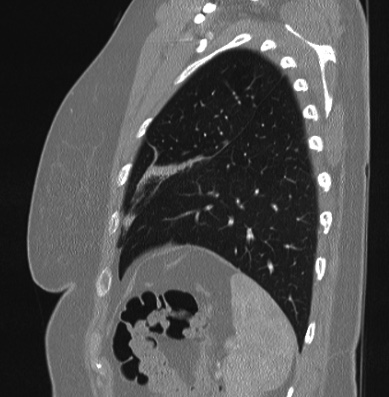 Cardiac sarcoidosis (Radiopaedia 74548-85534 Sagittal lung window 16).jpg