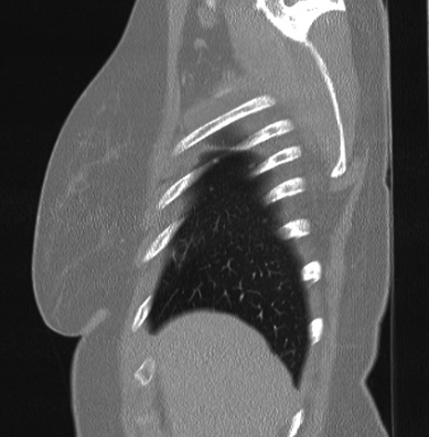 Cardiac sarcoidosis (Radiopaedia 74548-85534 Sagittal lung window 83).jpg