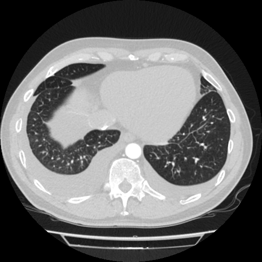 Cardiac tamponade (Radiopaedia 78607-91368 Axial lung window 73).jpg
