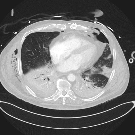 Cardiac trauma (Radiopaedia 32874-33858 Axial lung window 36).jpg