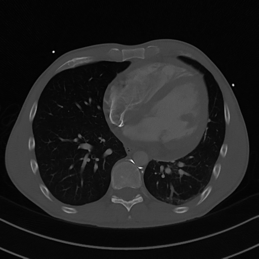 Cardiac tumor - undifferentiated pleomorphic sarcoma (Radiopaedia 45844-50134 Axial bone window 44).png