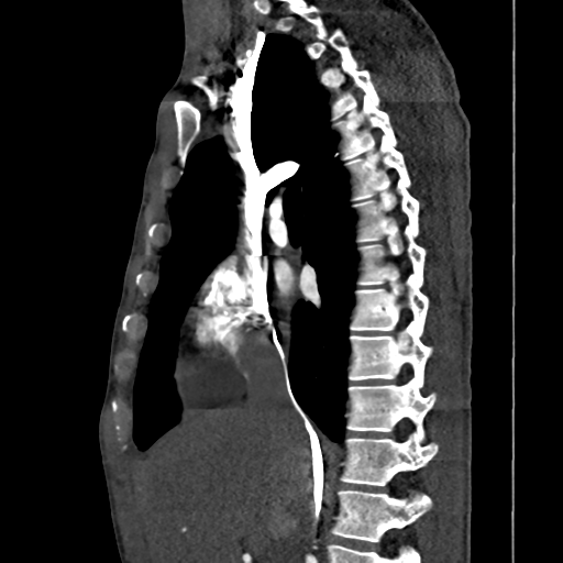 Cardiac tumor - undifferentiated pleomorphic sarcoma (Radiopaedia 45844-50134 B 47).png