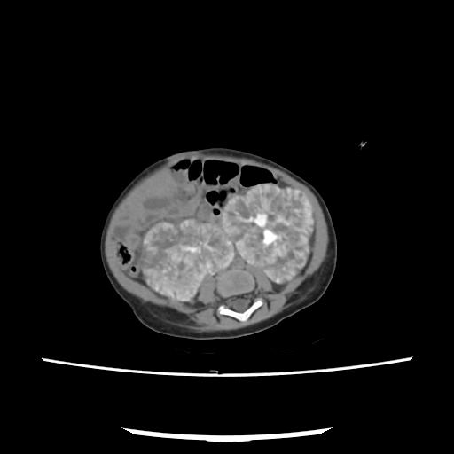 Caroli disease with autosomal recessive polycystic kidney disease (ARPKD) (Radiopaedia 89651-106703 E 157).jpg