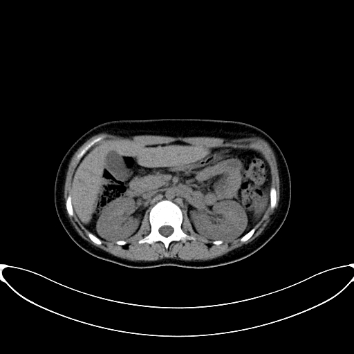 File:Caroli disease with medullary sponge kidney (Radiopaedia 82622-96804 Axial non-contrast 27).jpg