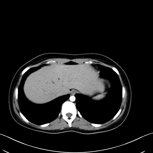 Caroli disease with medullary sponge kidney (Radiopaedia 82622-96804 C 14).jpg