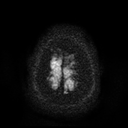 File:Carotid arterial dissection with acute cerebral infarction (Radiopaedia 26636-26784 Axial DWI 20).jpg