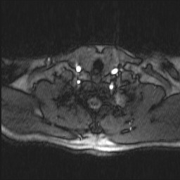 Carotid artery dissection (Radiopaedia 28441-28689 Axial MRA 13).jpg