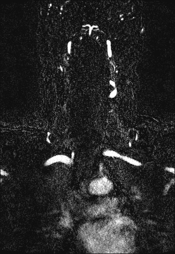 Carotid artery dissection (Radiopaedia 28441-28689 Coronal MRA 49).jpg