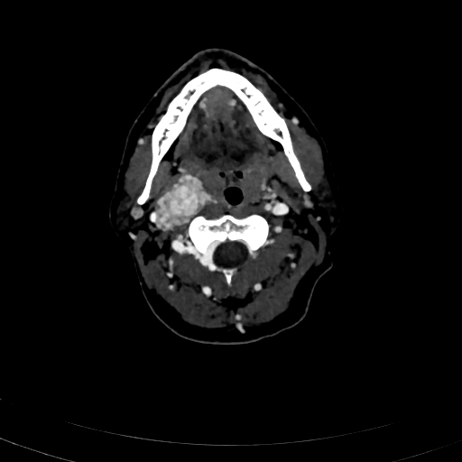 Carotid body tumor (Radiopaedia 83615-98727 D 47).jpg