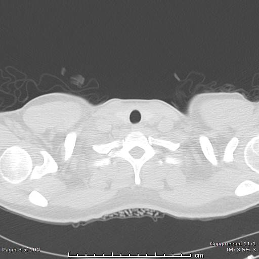 Catamenial pneumothorax (Radiopaedia 54382-60600 Axial non-contrast 3).jpg