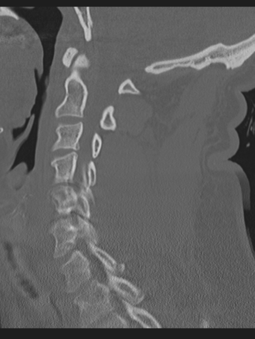Cavernoma of cervical cord (Radiopaedia 50838-56346 Sagittal bone window 36).png