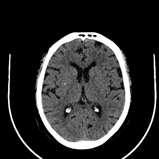Cavernous hemangioma of the cerebellar falx (Radiopaedia 73025-83723 Axial non-contrast 74).jpg
