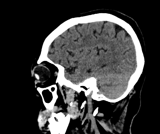 Cavernous hemangioma of the cerebellar falx (Radiopaedia 73025-83723 B 88).jpg