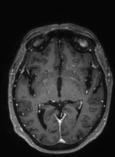 File:Cavernous hemangioma of the cerebellar falx (Radiopaedia 73025-83724 Axial T1 C+ 181).jpg