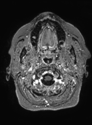 Cavernous hemangioma of the cerebellar falx (Radiopaedia 73025-83724 Axial T1 C+ 331).jpg