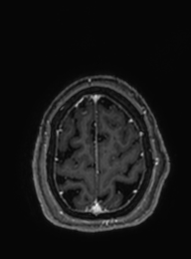 File:Cavernous hemangioma of the cerebellar falx (Radiopaedia 73025-83724 Axial T1 C+ 52).jpg
