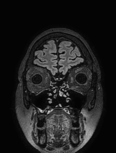 Cavernous hemangioma of the cerebellar falx (Radiopaedia 73025-83724 Coronal FLAIR 40).jpg