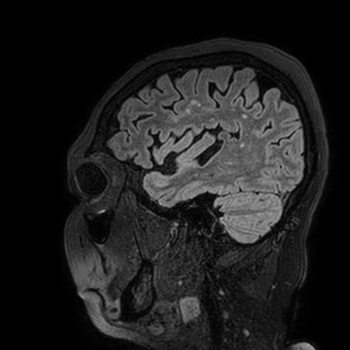 Cavernous hemangioma of the cerebellar falx (Radiopaedia 73025-83724 Sagittal FLAIR 173).jpg