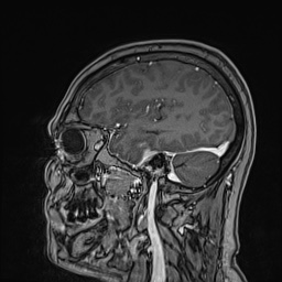 Cavernous sinus meningioma (Radiopaedia 63682-72367 Sagittal T1 C+ 56).jpg