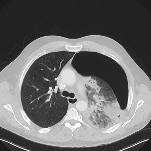 Cavitating pneumonia complicated by pneumothorax (Radiopaedia 48149-52994 Axial lung window 26).png