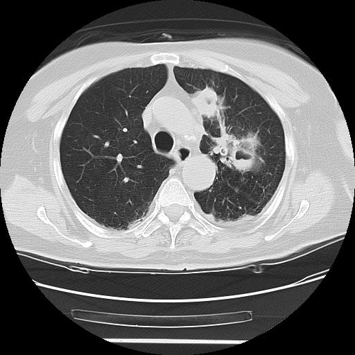 Cavitating pulmonary metastases (Radiopaedia 89545-106544 Axial lung window 19).jpg