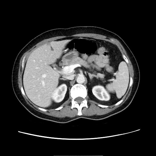 Cecal adenocarcinoma (Radiopaedia 75909-87331 A 30).jpg