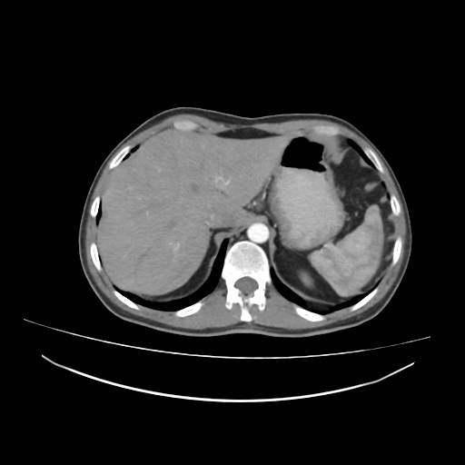 Cecal carcinoma with local lymphadenopathy (Radiopaedia 31428-32240 A 7).jpg