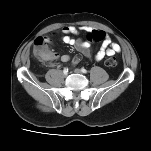 Cecal mass causing appendicitis (Radiopaedia 59207-66531 A 60).jpg