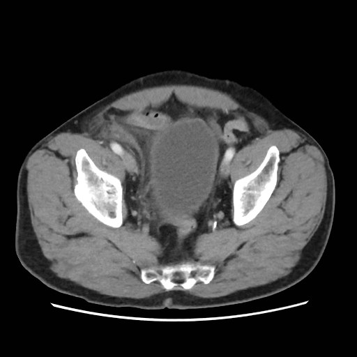 Cecal mass causing appendicitis (Radiopaedia 59207-66531 A 76).jpg