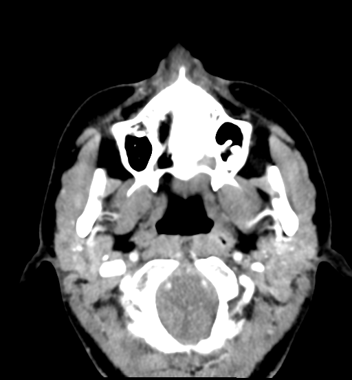 File:Cemento-ossifying fibroma (Radiopaedia 46243-50643 Axial C+ delayed 29).png