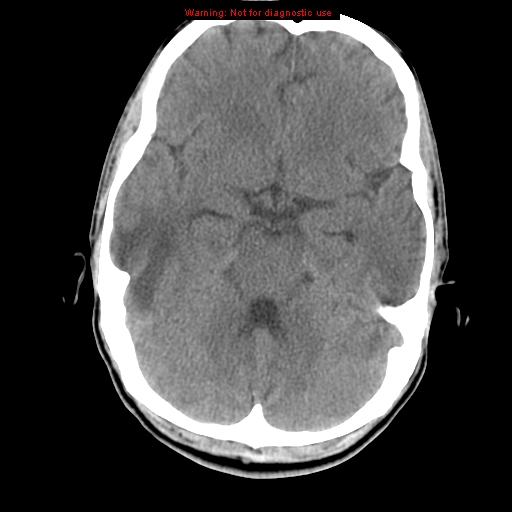 File:Central nervous system vasculitis (Radiopaedia 8410-9234 Axial non-contrast 9).jpg
