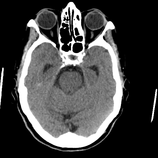 File:Central neurocytoma (Radiopaedia 65317-74346 Axial non-contrast 17).png