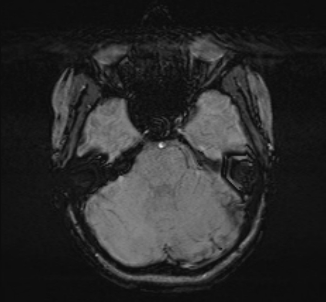 Central neurocytoma (Radiopaedia 70263-80336 Axial SWI 14).jpg