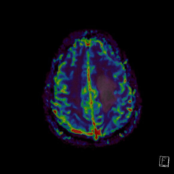 Central neurocytoma (Radiopaedia 84497-99872 Axial Perfusion 66).jpg