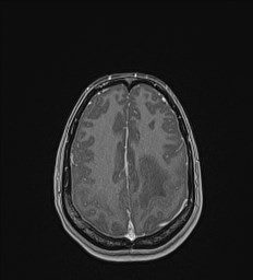 File:Central neurocytoma (Radiopaedia 84497-99872 Axial T1 C+ 120).jpg