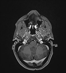 Central neurocytoma (Radiopaedia 84497-99872 Axial T1 C+ 31).jpg